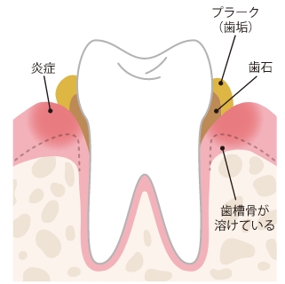 歯周病説明図