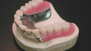 金属床義歯(自費診療)