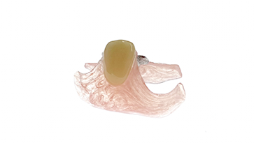 ノンクラスプデンチャー